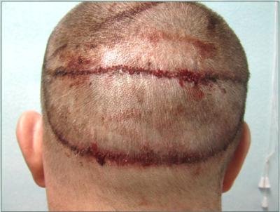  Hair Transplant on Surgery  Scalp Involved  Hair Transplants By Fue Bht   Dermhairclinic