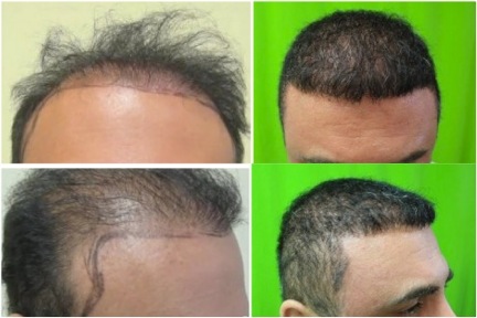 FUE hair transplant repair | beard hair grafts | impossible case