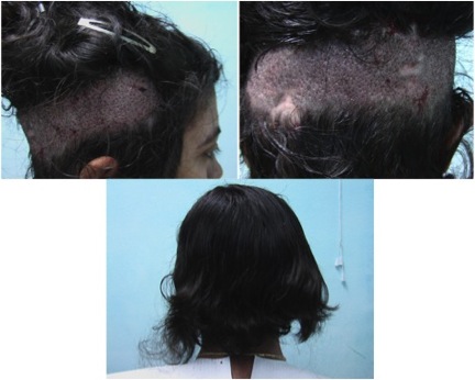 female patient hair restoration | Lupus