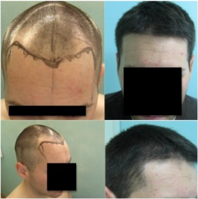  Hair Transplant on Fue Hair Restoration  Fue Sfet  To Create Agressive Hairline