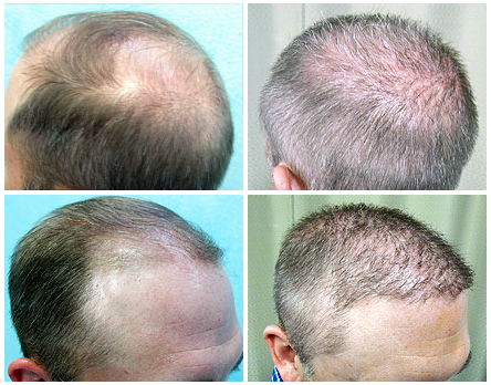  Hair Transplant on Fue Hair Transplant Uses Donor Hair From Nape  Beard  And Body