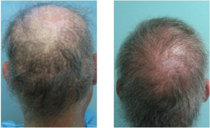 Rear views of before and after this patient's body hair to scalp transplant.