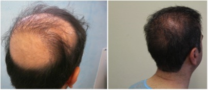 Crown Hair Transplant|enhancing coverage with body hair
