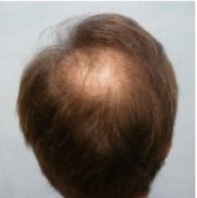 Crown Hair Transplant|restoration surgery