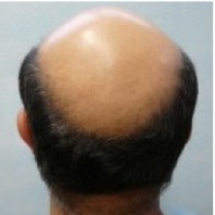 Crown Hair Transplant|severe baldness