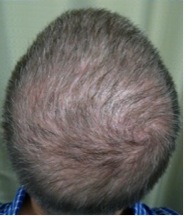 Crown Hair Transplant| restoring whorl
