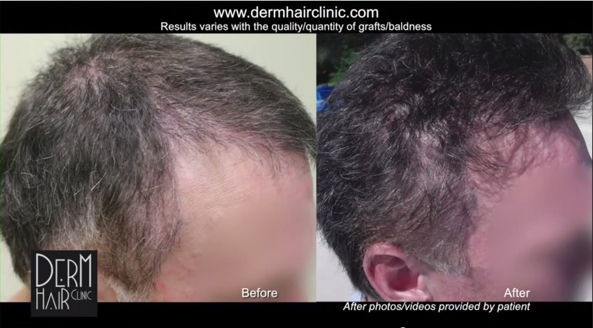 http://www.dermhairclinic.com/wp-content/uploads/2014/06/body-hair-transplant-04561.jpg