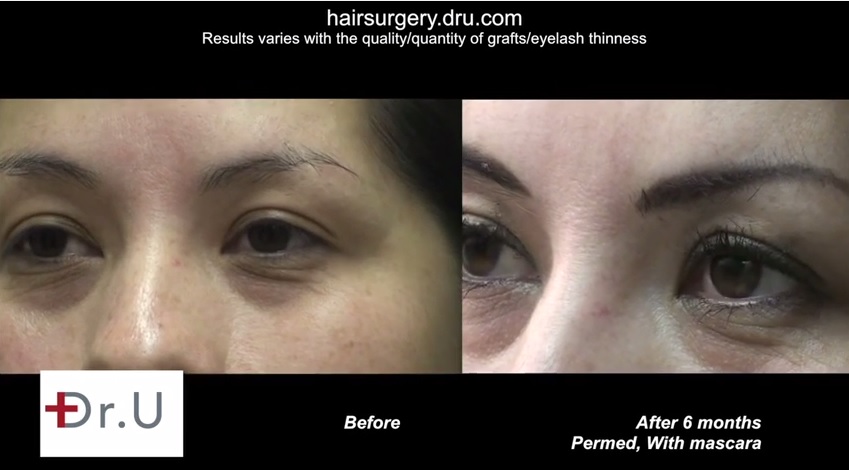 http://www.dermhairclinic.com/wp-content/uploads/2014/08/eyelash-transplant-0342345.jpg
