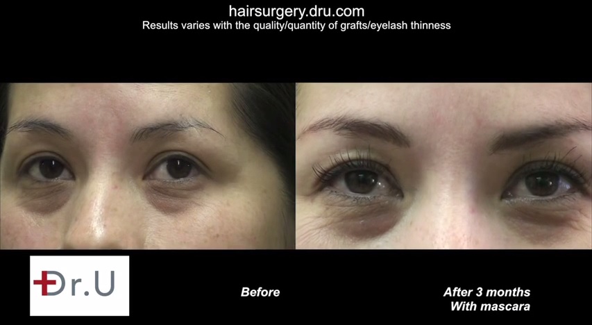http://www.dermhairclinic.com/wp-content/uploads/2014/08/eyelash-transplant-0343234.jpg