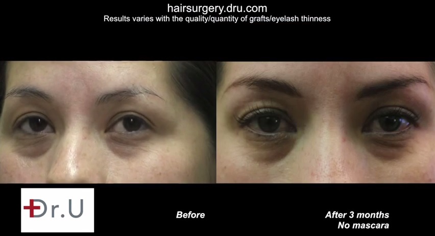 http://www.dermhairclinic.com/wp-content/uploads/2014/08/eyelash-transplant-04344.jpg