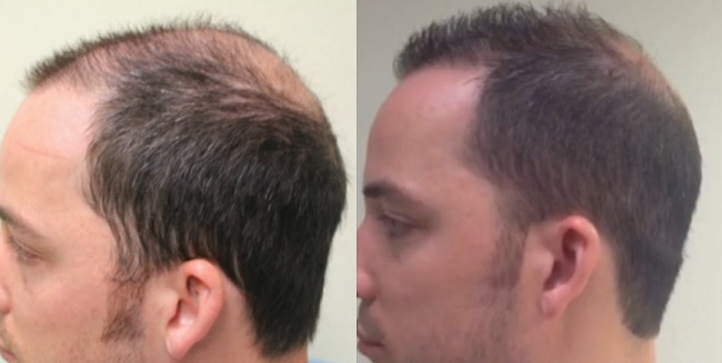 before-after-hairline-crown-temples.jpg