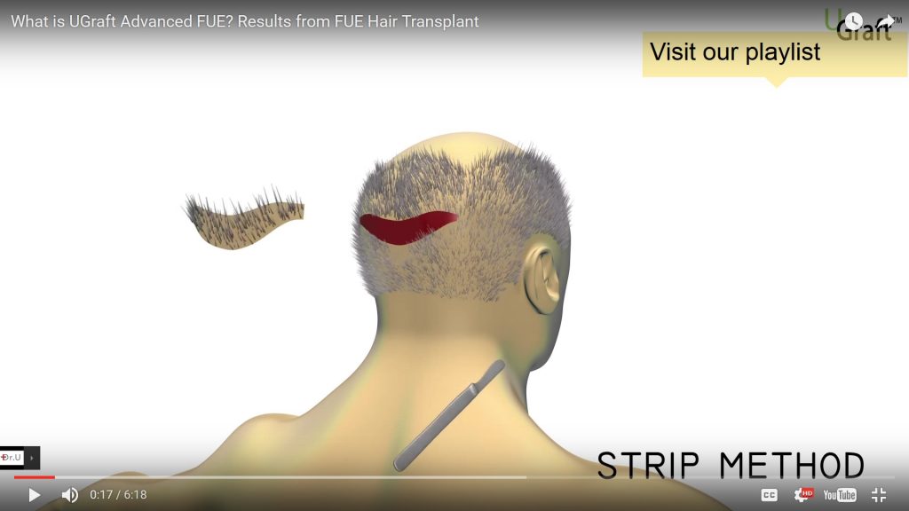 Removal of a strip of flesh with a knife in older strip surgery method of hair restoration