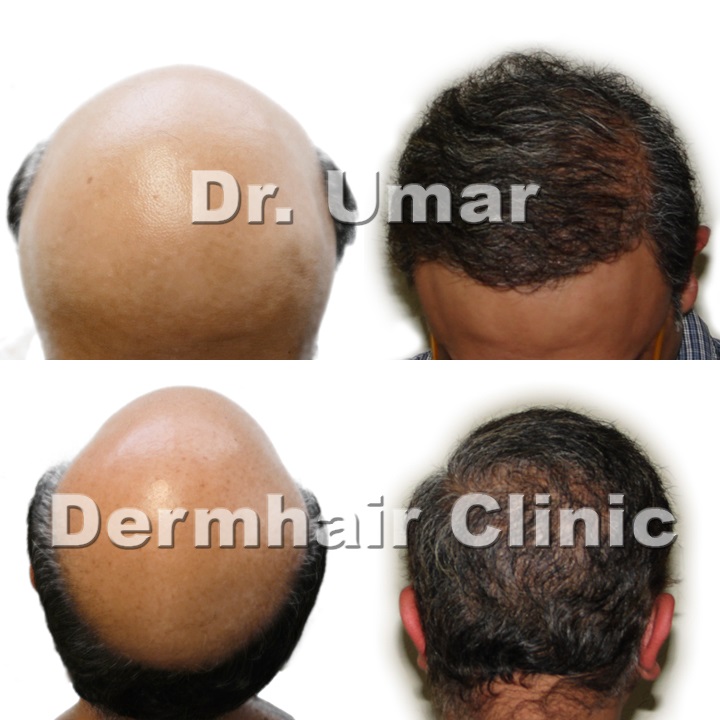 Los Angeles UGraft follicular unit extraction using 12000 combination head and body hair grafts for severe level 7 baldness - Before and after photos