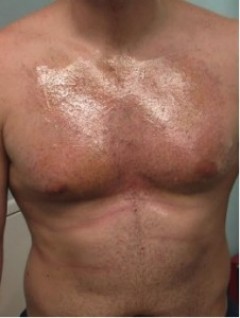 Example of a chest hair harvest soon after an “UGraft follicular unit extraction in Dr Umar' Los Angeles Clinic