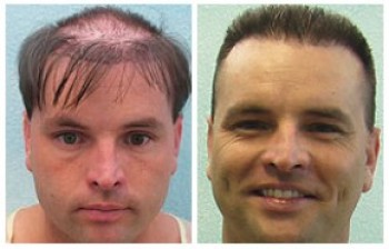 body-hair-transplant-results-2-e1330287804109.jpg