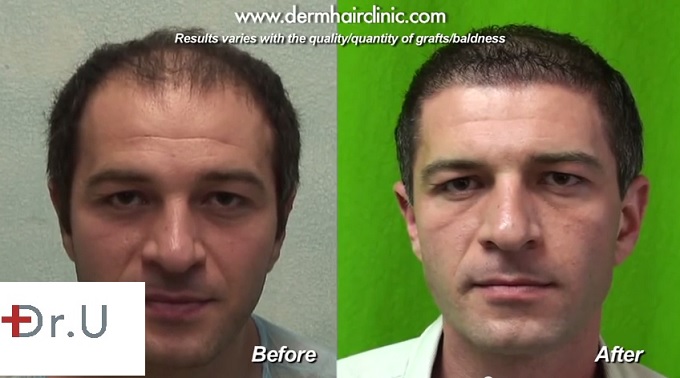 10000 Graft Implants  Amazing Hair Transplant Results Before and After  Images of Hair Transplant  YouTube