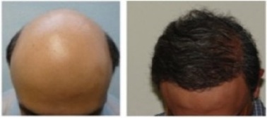FUE Hair Restoration Cost 1