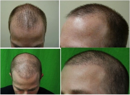 Best Hair Restoration in the World 6