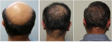 Crown Hair Transplant - DermHair Clinic Los Angeles 1-310 ...