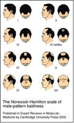 Follicular Unit Extraction Info | stages of Male Pattern Baldness