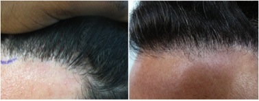 Follicular Unit Extraction Info|refining hairline