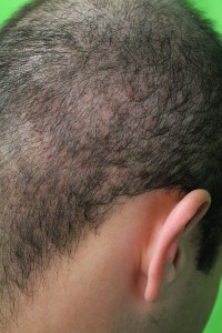 Reversing Hair Loss with FUE Restoration
