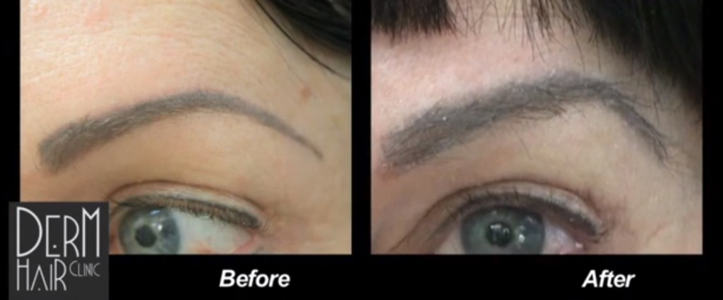 Eyebrow Hair Transplant Process: How Does it Work?