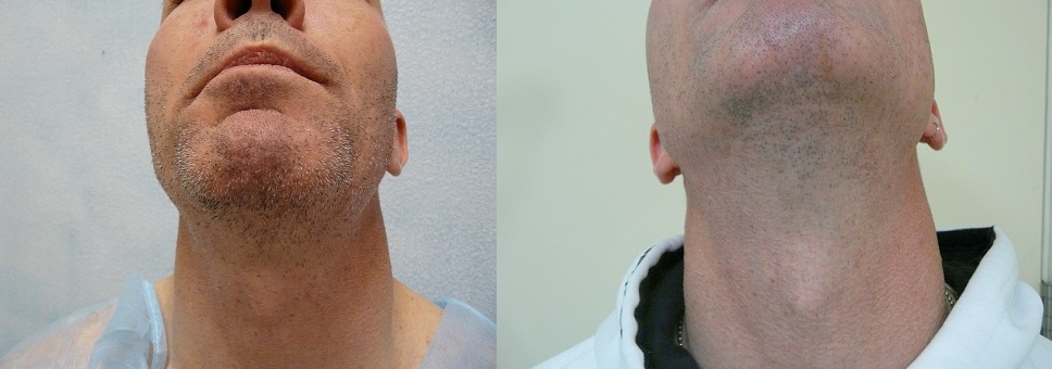 Body Hair Transplant Wound Healing - DermHair Clinic LA 1-310-318-1500