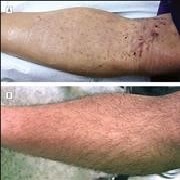 BHT | donor wound healing | leg hair grafts