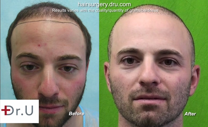 https://www.dermhairclinic.com/wp-content/uploads/2015/04/BHT-patient-before-after-facial-view.jpg