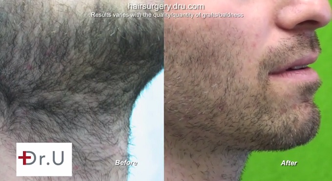 https://www.dermhairclinic.com/wp-content/uploads/2015/04/beard-donor-before-after-bht-surgery.jpg
