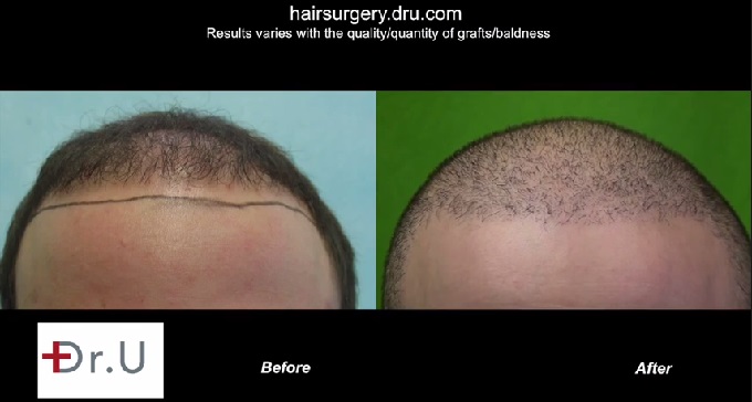 https://www.dermhairclinic.com/wp-content/uploads/2015/04/bht-new-hairline-before-after.jpg