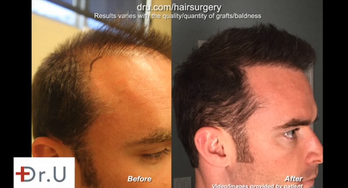 temple-hair-restoration-BHT-results.jpg
