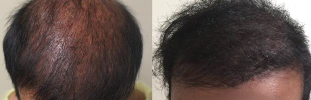 Bad Fue Hair Transplant Planning: Head Donor Over Harvesting, Poor 