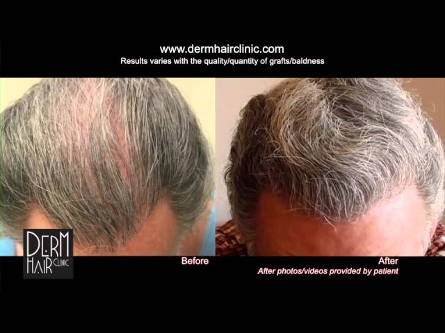 FUE Hair Transplant Cost Determining Factors