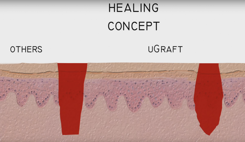 UGraft wounds are relatively more inverted or straight edged compared to typical FUE punches