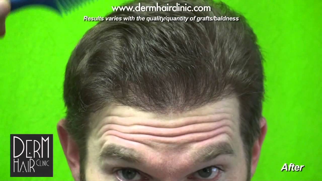 Receding Hairline, FUE Treatment & Patient Photos ...