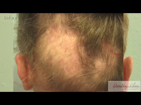 The Worst Hair Transplant Repair Patient Testimonial by Anonymous