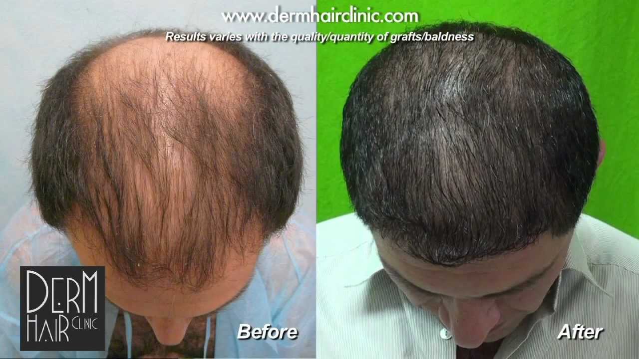 UGraft FUE Hair Transplant For Level 6 Baldness With 10000 Grafts