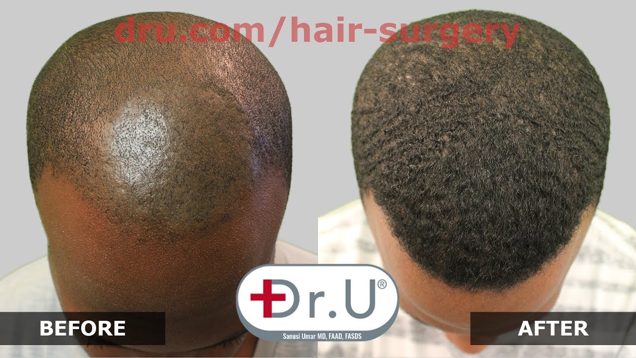 VIDEO - FUE Punch for African American Hair Transplant, Dr ...